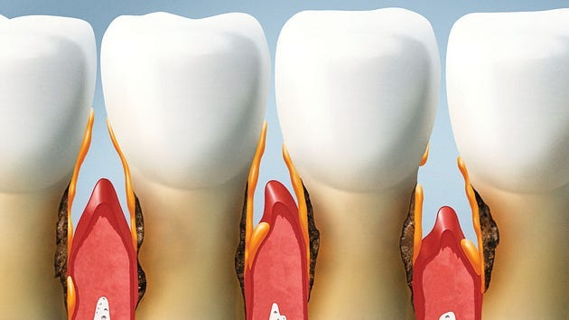 Gum Disease
