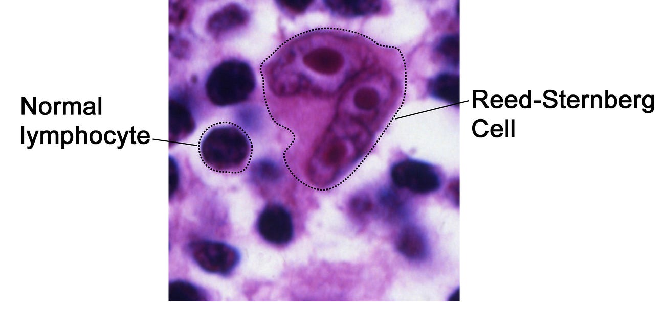 Epstein-Barr Virus: More maladies than merely mono
