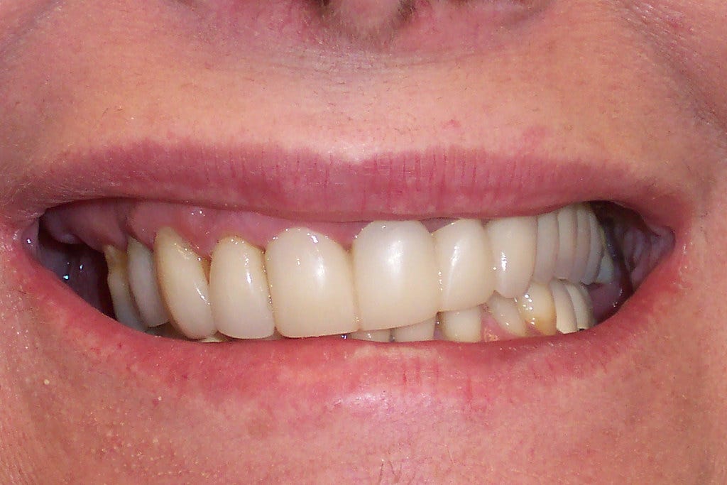 slanted smile before crownlengthening | Recession before Las… | Flickr
