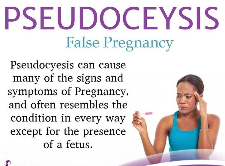 Gynae Associates on Twitter: "Have you ever heard of Pseudocyesis, Better  known as a False Pregnancy? Do you know anyone this has happened to?  #gynaecology #pseudocyesis #falsepregnancy #obstetrician #gynaeassociates  #gynaecologist ...