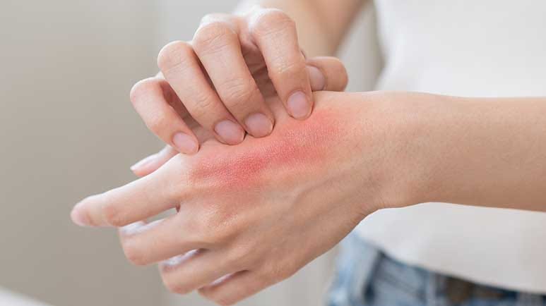 hand dermatitis natural treatment