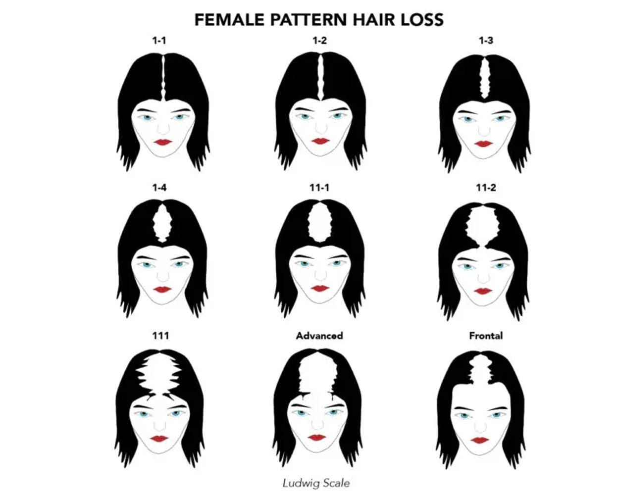 Hair Loss Stages in Females | Ludwig Scale | Treatment Rooms London
