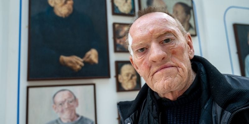 Robin wearing his facial prosthesis standing in front of his portraits Robin wearing his facial prosthesis standing in front of his portraits