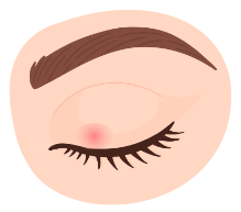 Ocular rosacea
