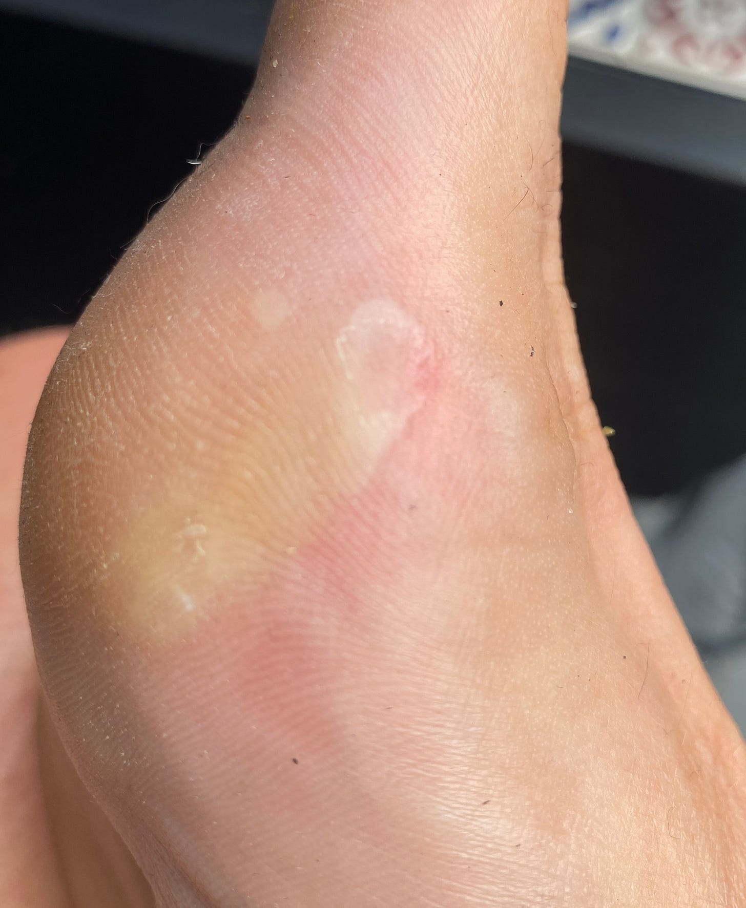 blisters showing on the side of foot