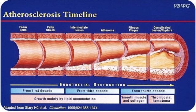 Risk for Atherosclerosis - Itamar Medical