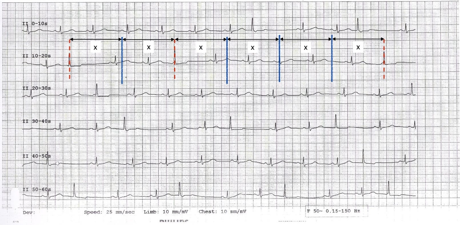 Annotated 60-second lead II rhythm strip. Vertical lines mark ectopic beats (blue, solid) and expected but blocked ectopic beats (red, dashed). Horizontal arrows labelled X show equal intervals between consecutive firings. Annotated 60-second lead II rhythm strip. Vertical lines mark ectopic beats (blue, solid) and expected but blocked ectopic beats (red, dashed). Horizontal arrows labelled X show equal intervals between consecutive firings.