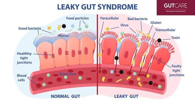 All You Need To Know About Suffering From Leaky Gut Syndrome All You Need To Know About Suffering From Leaky Gut Syndrome
