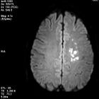 Thank You, Brain — A Stroke as a Gift