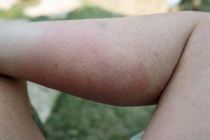 Welts and swelling on my legs from wasp stings