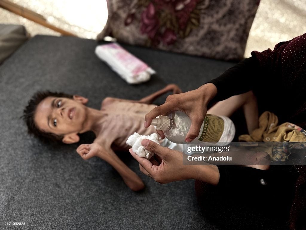 6-year-old Palestinian boy suffers malnutrition due to blockade in Gaza