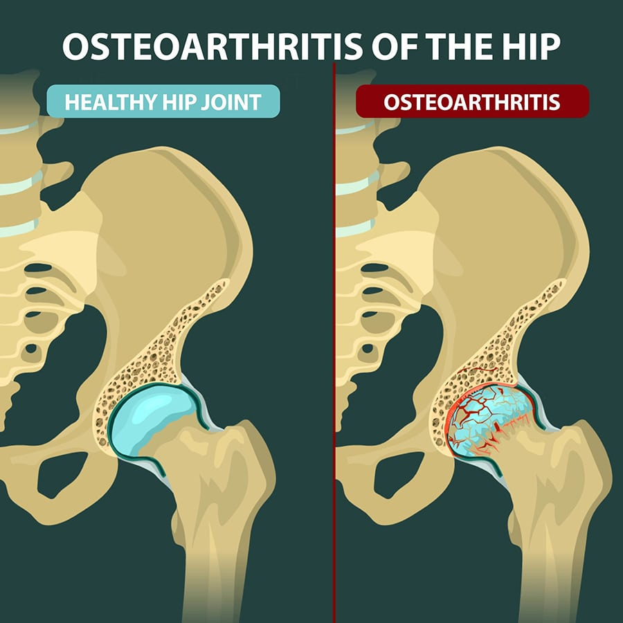 Osteoarthritis of the Hip | Florida Orthopaedic Institute