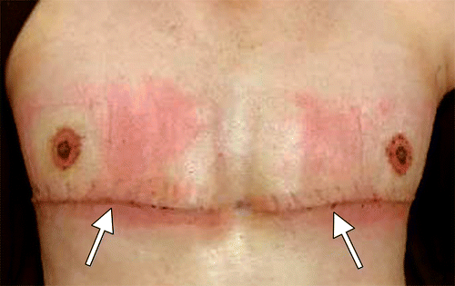 Imaging Findings in Transgender Patients after Gender-affirming Surgery |  RadioGraphics