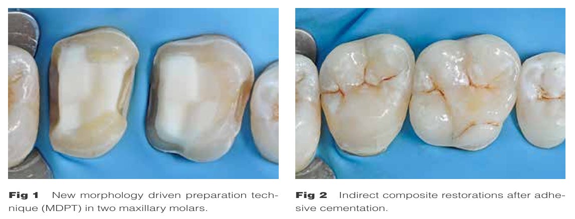 Post Indirect Kit Posterior indirect adhesive restorations: updated indications and the ...