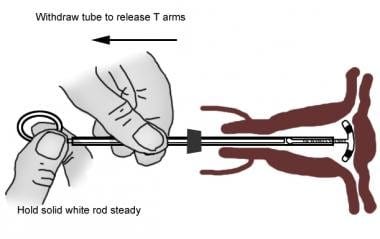 Intrauterine Device Insertion: Overview, Periprocedural Care, Technique