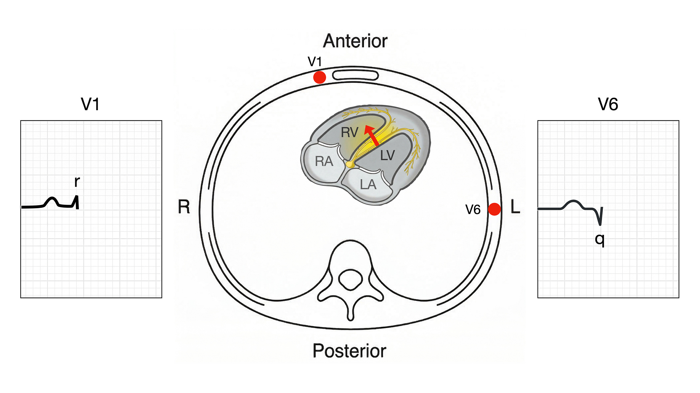 Phase 1 of normal ventricular depolarisation showing septal activation with a small r wave in V1 and q wave in V6