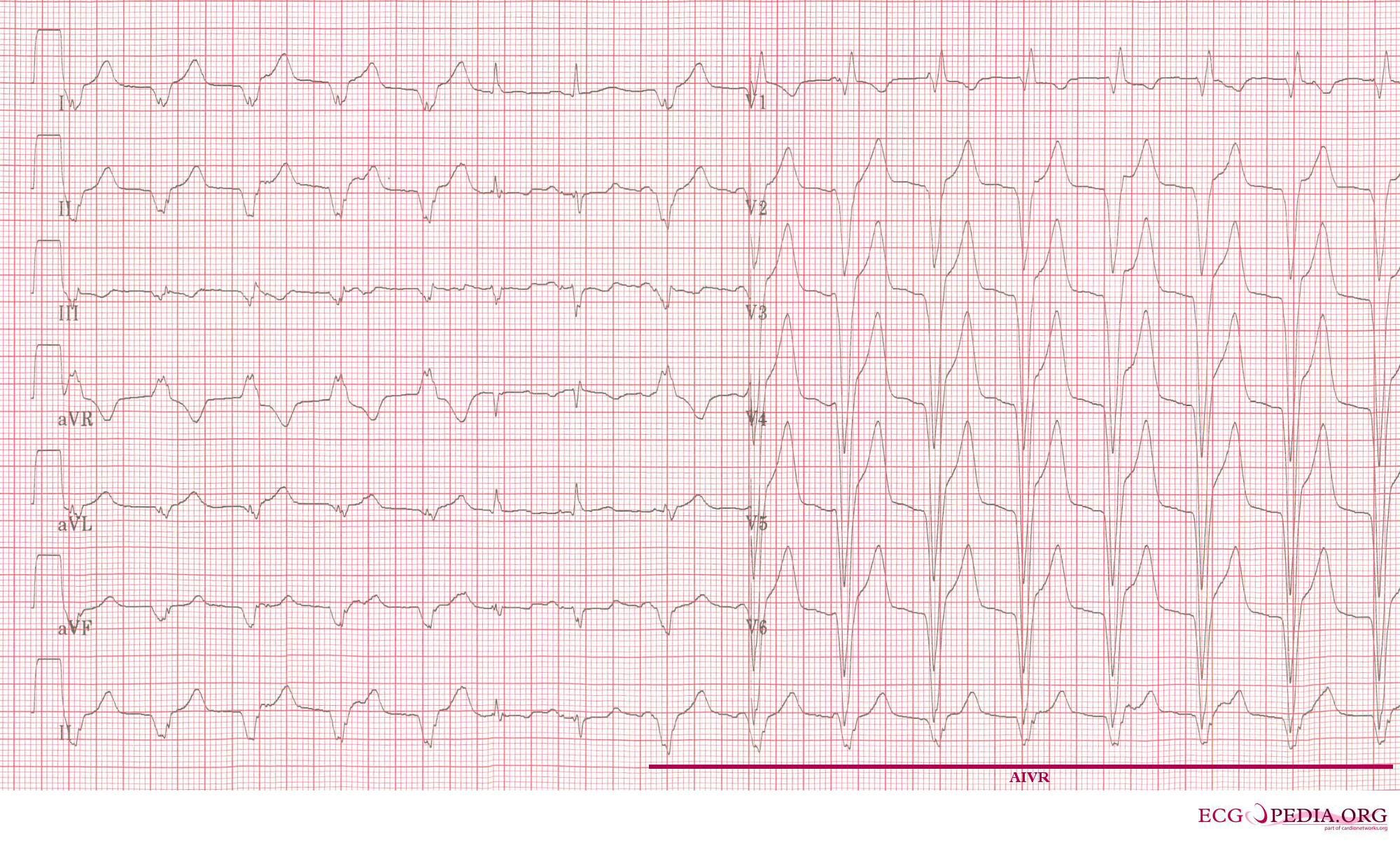 Accelerated idioventricular rhythm: wide QRS with capture and fusion beats and AV dissociation