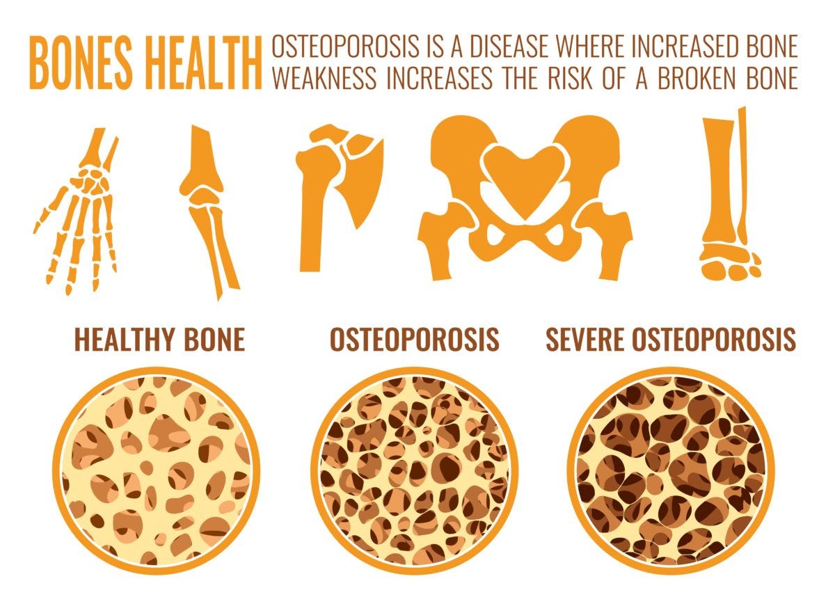 Decrease the Risk of Osteoporosis with Exercise - Propel Physiotherapy