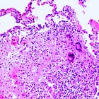 260 Children Infected with Tuberculosis in Gates-Funded Study Injecting Children with Live Mycobacterium bovis Bacteria: 'New England Journal of Medicine'