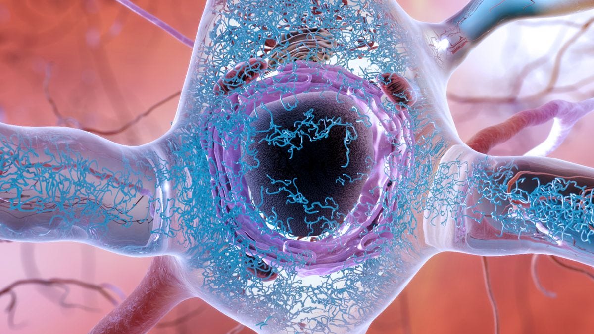 Inside a neuron with Alzheimer's: abnormal tau, in blue, spreading through the cell. Inside a neuron with Alzheimer's: abnormal tau, in blue, spreading through the cell.
