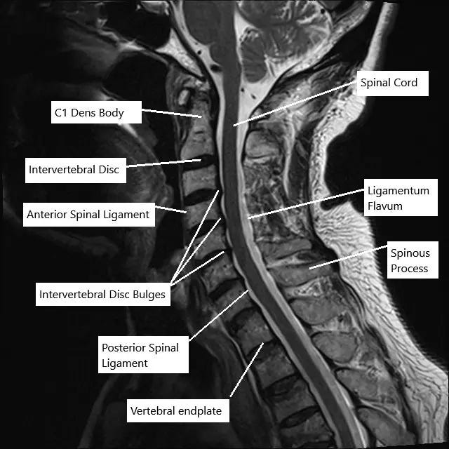 Cervical Spinal Stenosis - Complete Orthopedics & Podiatry