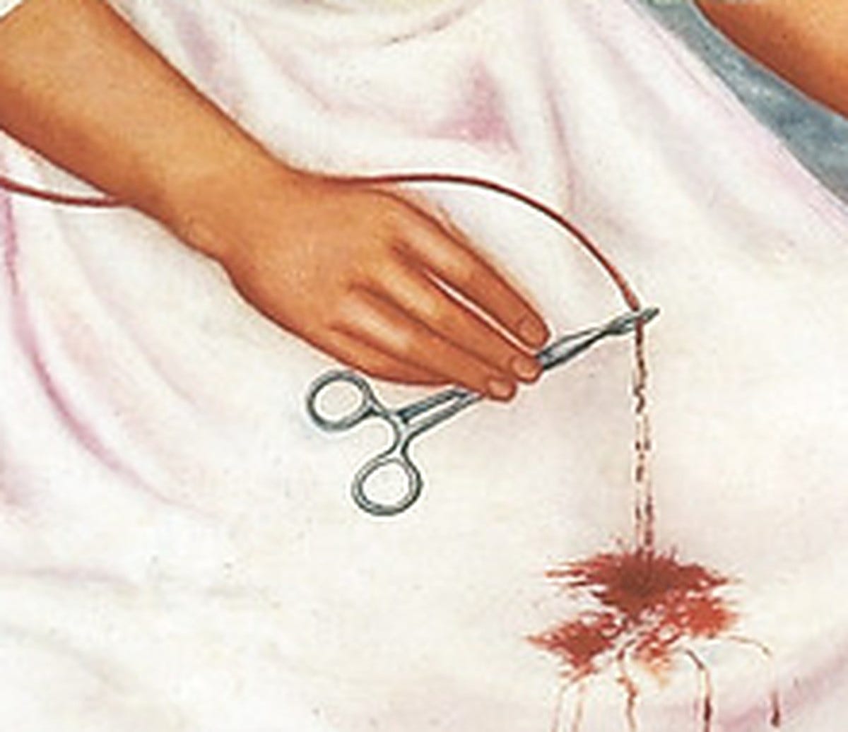 A surgical clamp with two finger rings, held in a hand and closed on a vein, with blood dripping onto a white skirt. A surgical clamp with two finger rings, held in a hand and closed on a vein, with blood dripping onto a white skirt.
