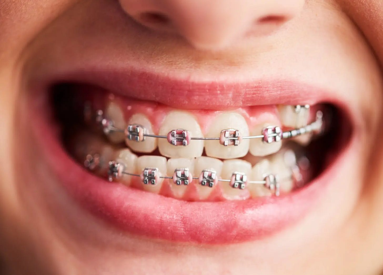 Cost of Braces in Port Elizabeth | A Comprehensive Guide