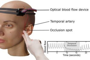 Setup of the laser speckle contrast optical spectroscopy system used to monitor scalp and brain blood flow during temporary blockage of a major scalp artery near the temple.