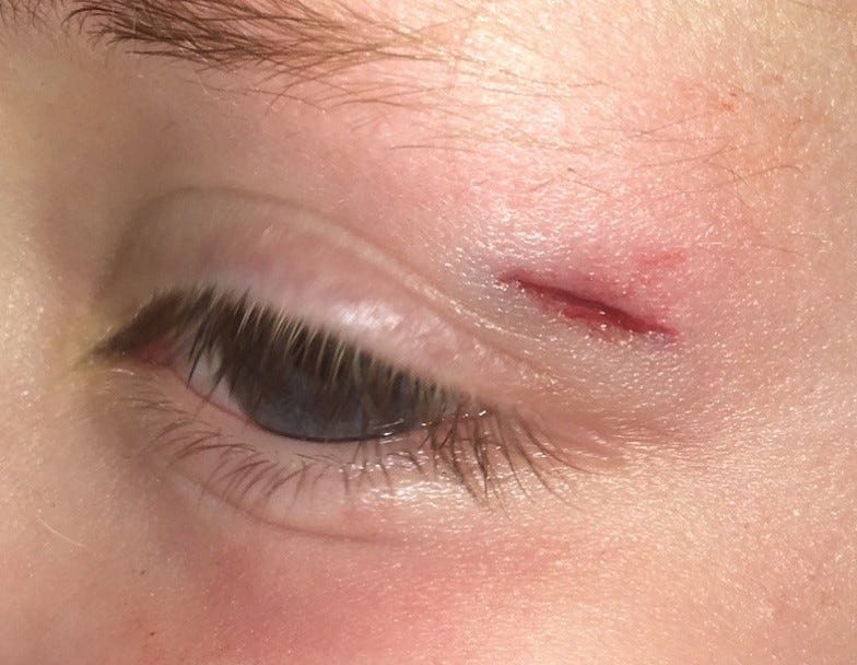 Eyelid Laceration - Best Wound Practice