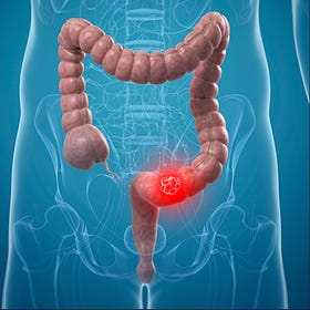 Case Report: Sigmoid Colon Adenocarcinoma Stage II, age 70, Female