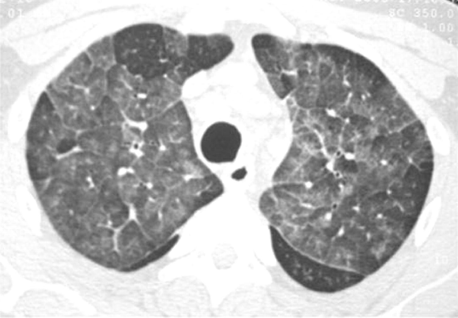 An unusual cause of patchy ground-glass opacity | Thorax An unusual cause of patchy ground-glass opacity | Thorax