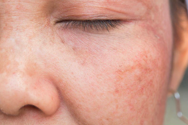skin hyperpigmentation causes uneven skin color skin hyperpigmentation causes uneven skin color
