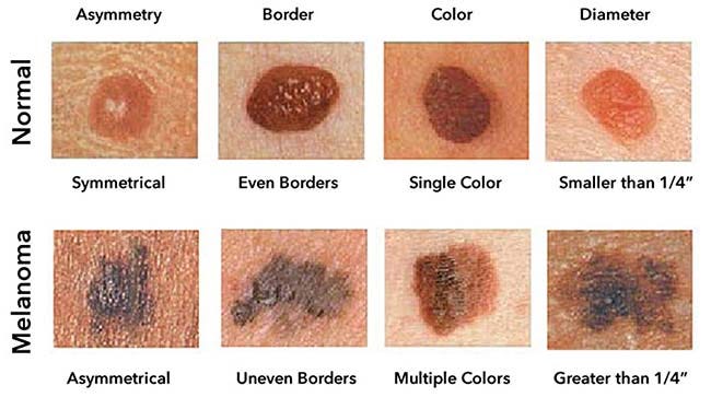 melanoma