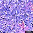 Cancer Reappears in Patient Following COVID-19 Vaccination: Peer-Reviewed Journal 'Infection' Case Study