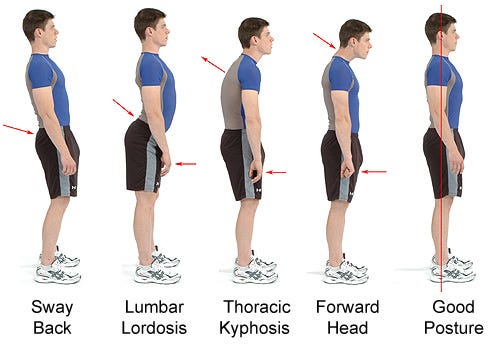 Lordosis: Guide To Causes, Symptoms, And Treatments