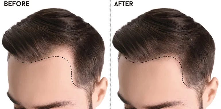 https://kopelmanhair.com/wp-content/uploads/2025/03/hairline-design-Importance-in-hair-transplant.webp