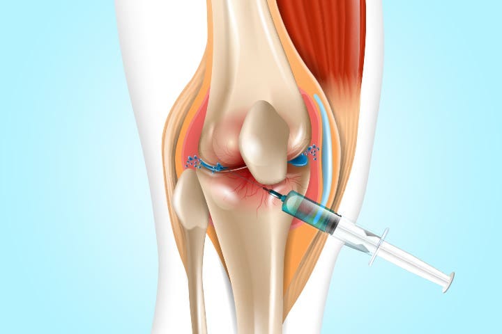 Joint Injections: Are They Worth the Risk? | MedPage Today