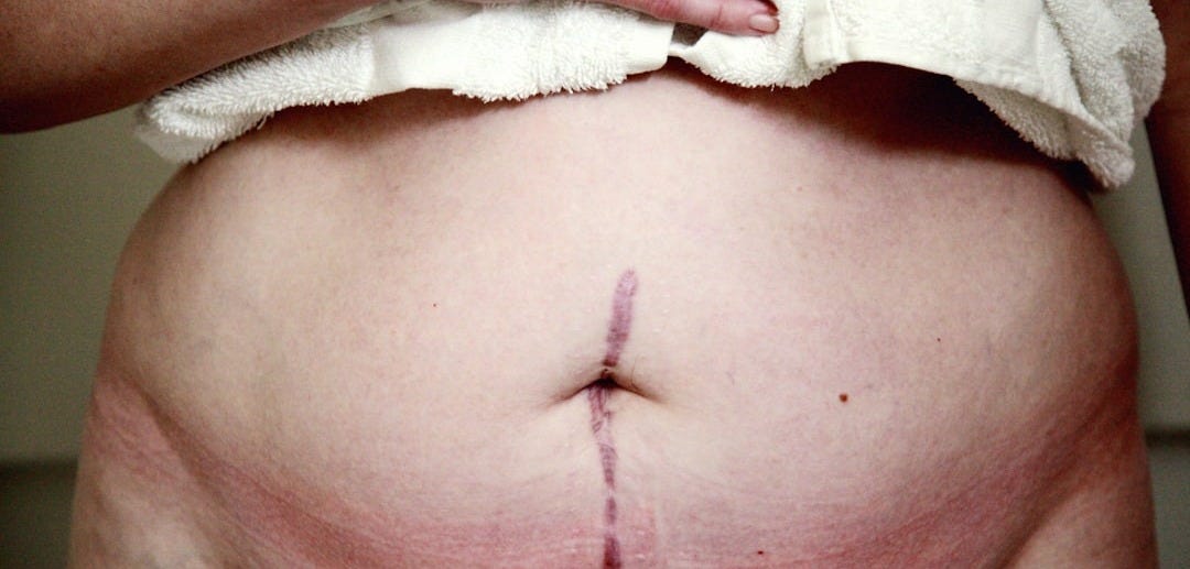 a person with a towel on their back