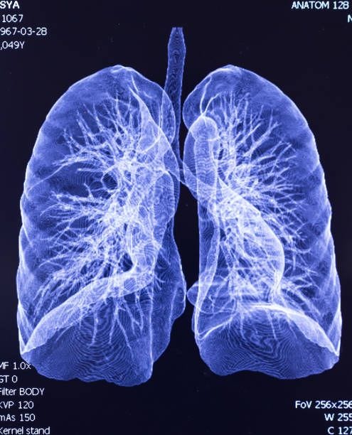 CAT Scan lung lobe CAT Scan lung lobe lung mri stock pictures, royalty-free photos & images