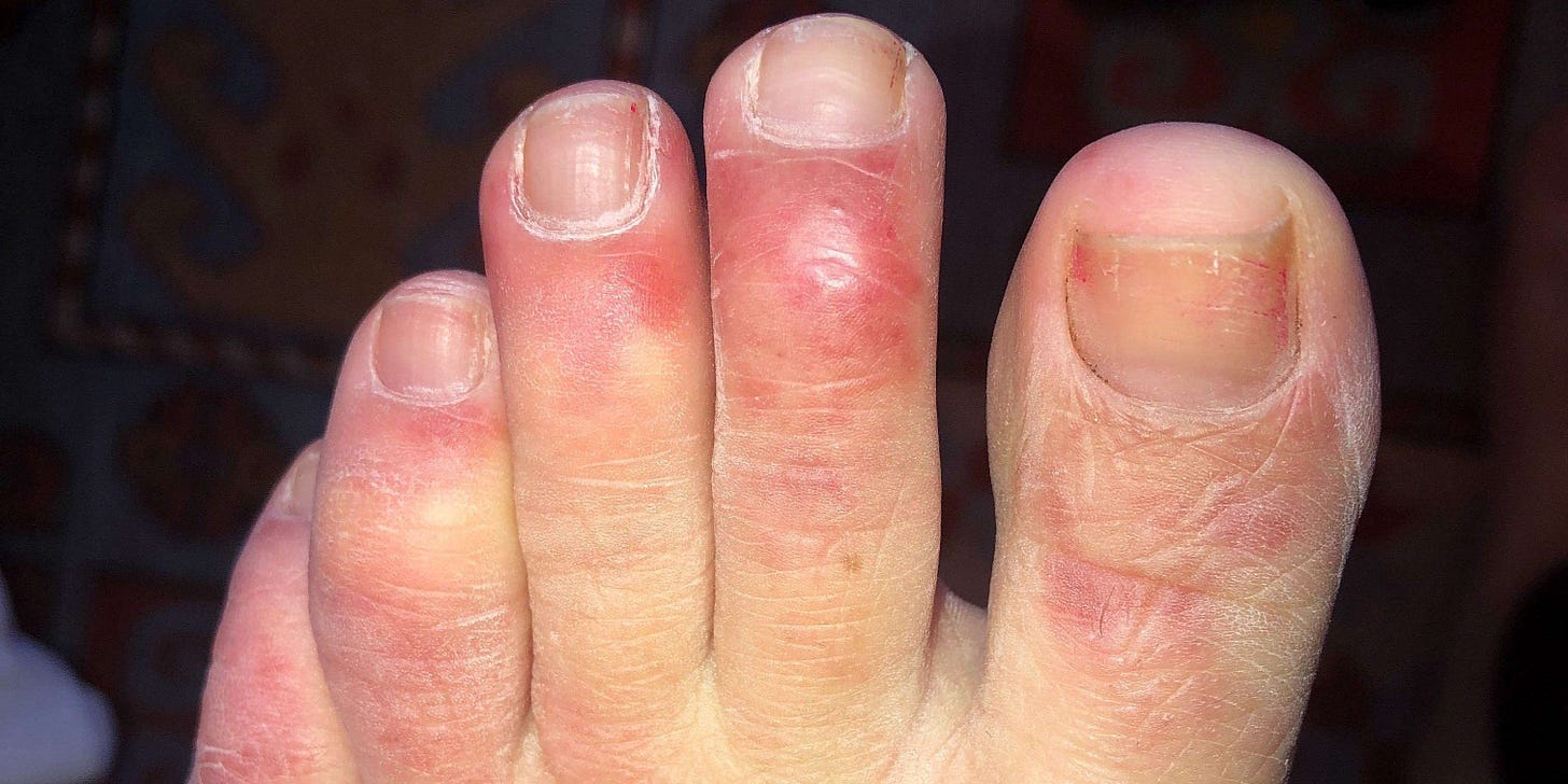 Some coronavirus patients may develop 'COVID tongue' - a ... Some coronavirus patients may develop 'COVID tongue' - a ...