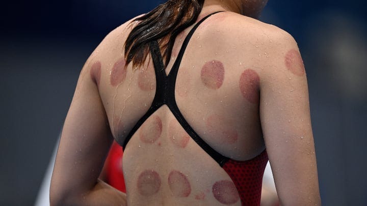 An Olympic swimmer sports circular bruises from cupping therapy. An Olympic swimmer sports circular bruises from cupping therapy.