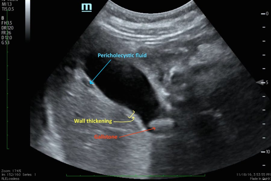 A Case of Acute Cholecystitis - JETem