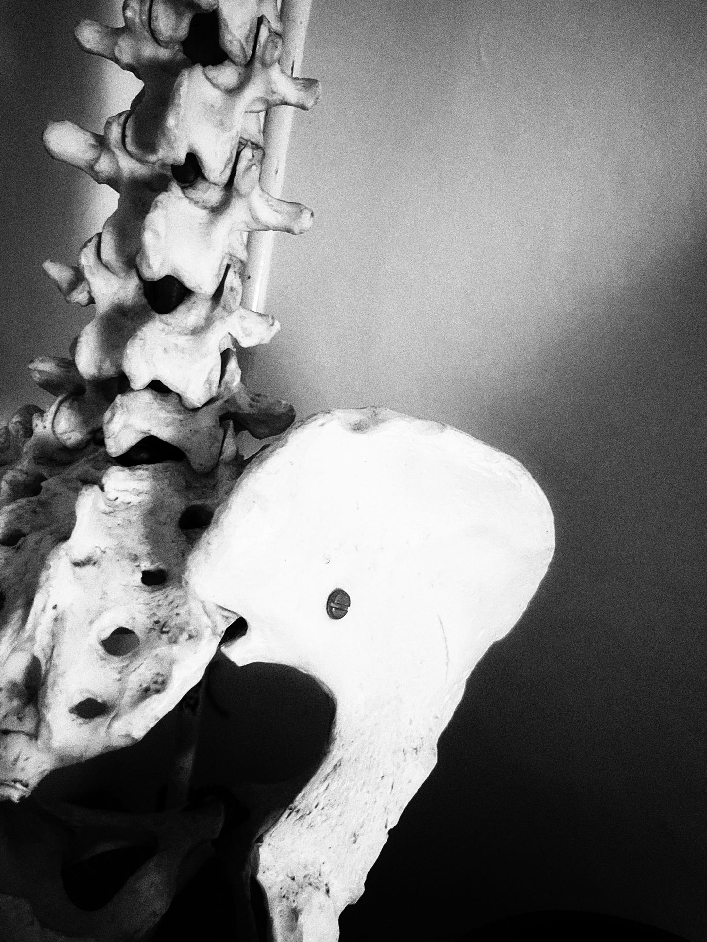 A black and white photo of a plaster model of a pelvis and spine. The back right side of the pelvis, most of the sacrum, and some of the lumbar vertebrae are visible. There is a screw in almost the middle of the hip bone connecting it to the sacrum.