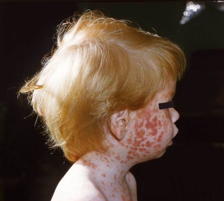 Large, red, raised patches cover a child’s cheek in such quantity that many of the patches connect to one another and only small strips of normal skin show through between. The red patches continue in a less dense pattern down the child’s neck and onto his chest. Large, red, raised patches cover a child’s cheek in such quantity that many of the patches connect to one another and only small strips of normal skin show through between. The red patches continue in a less dense pattern down the child’s neck and onto his chest.