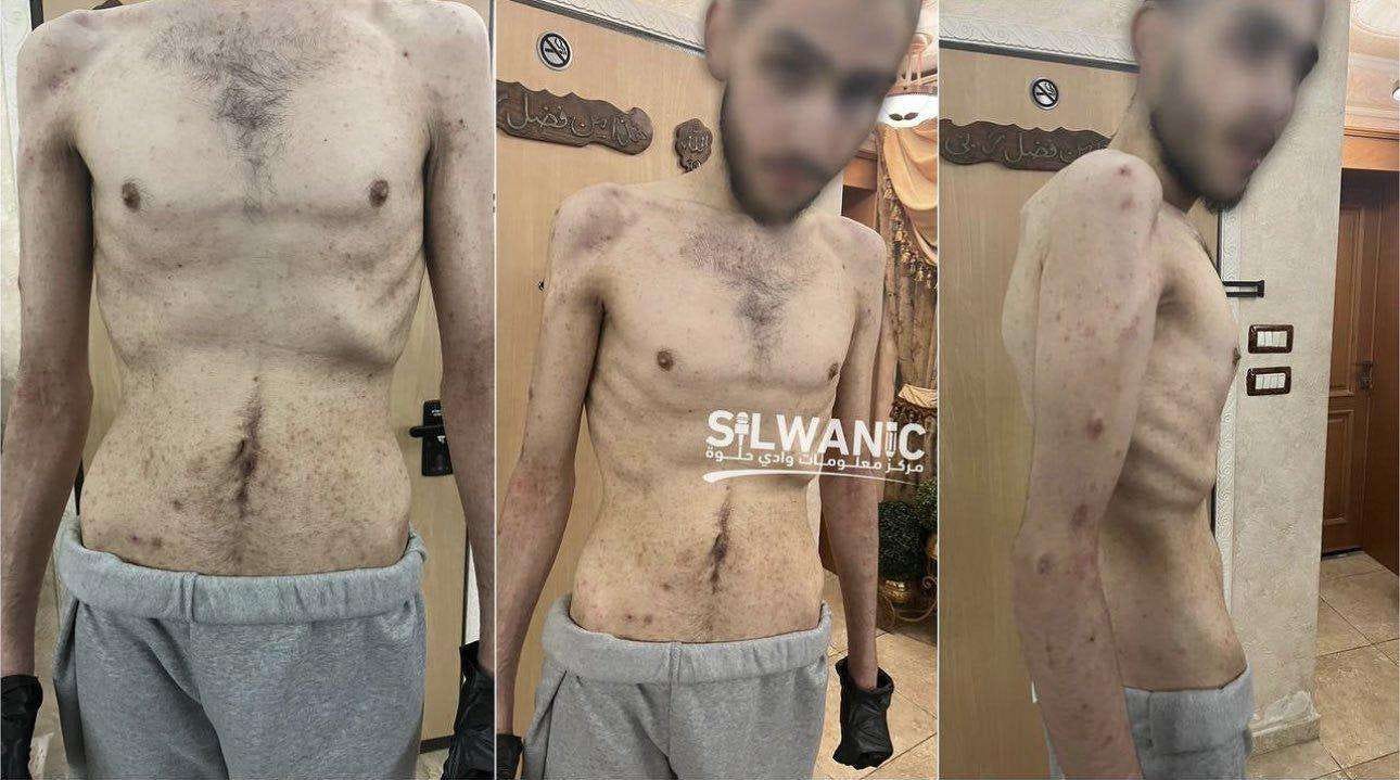 "Grave for the Living": The health status of Palestinian prisoners recently released from Israeli jails indicates their systematic malnutrition and torture "Grave for the Living": The health status of Palestinian prisoners recently released from Israeli jails indicates their systematic malnutrition and torture