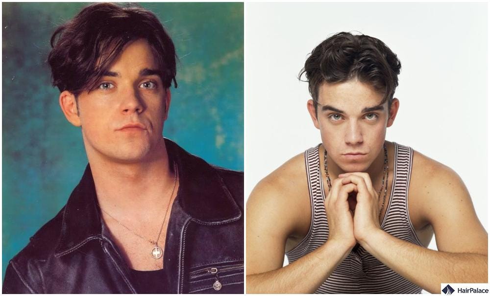 The Robbie Williams Hair Transplant Story