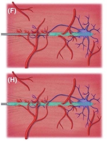 retroinjeção de preenchedores