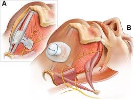 The Genio Neurostimulation system ...