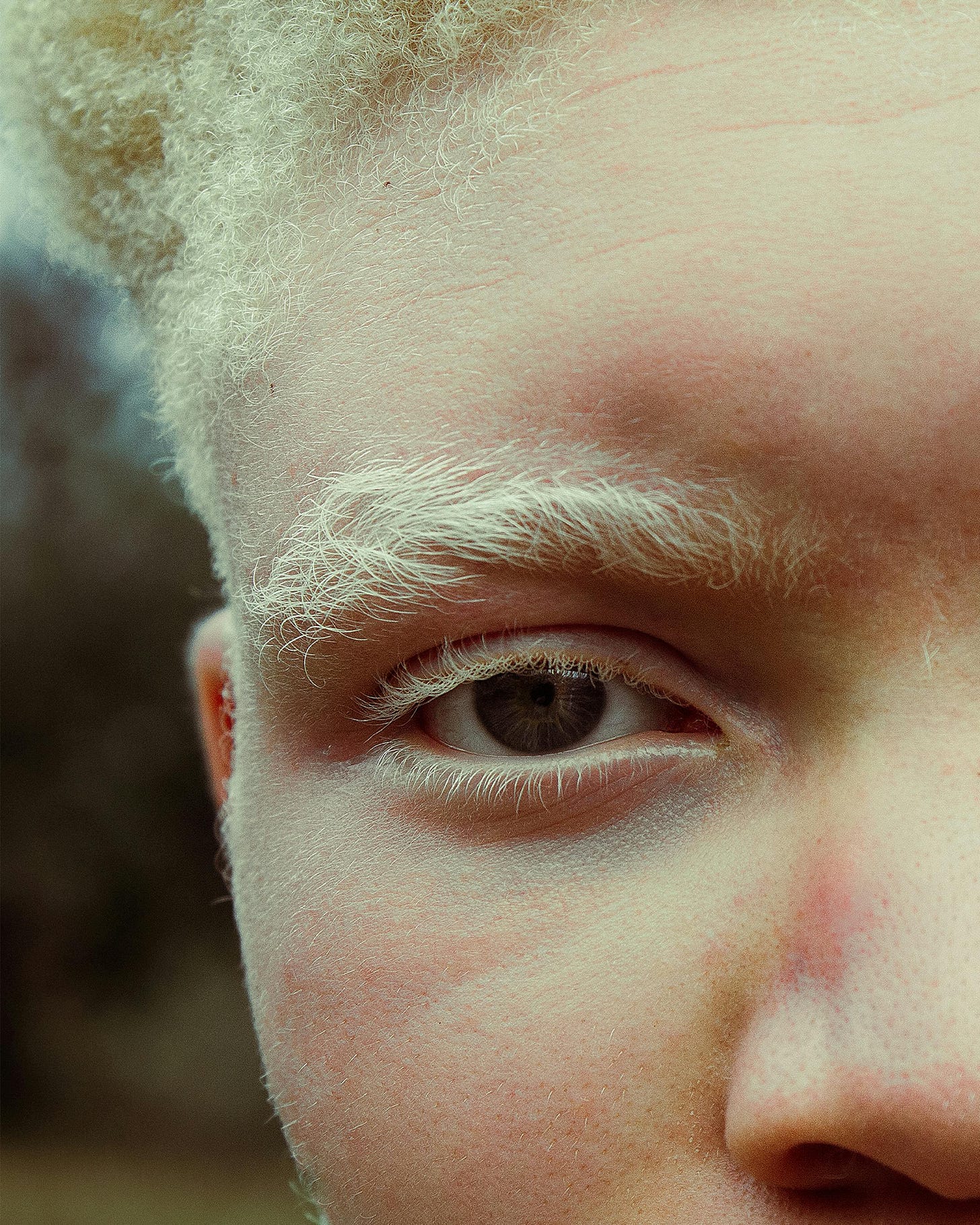 Close-up Portrait of Person with Albinism Outdoors · Free Stock Photo Close-up Portrait of Person with Albinism Outdoors · Free Stock Photo