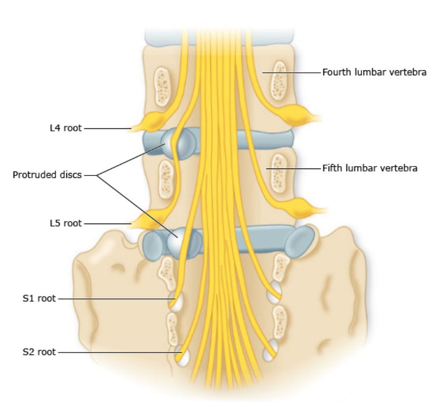 Sam LaPorta disc herniation illustration Sam LaPorta disc herniation illustration